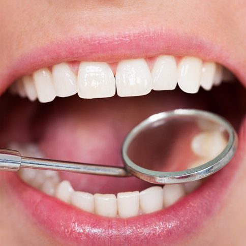 Teeth are inspected with dental mirror