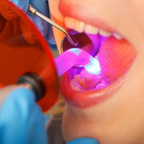 Closeup of smile during cosmetic dental bonding treatment
