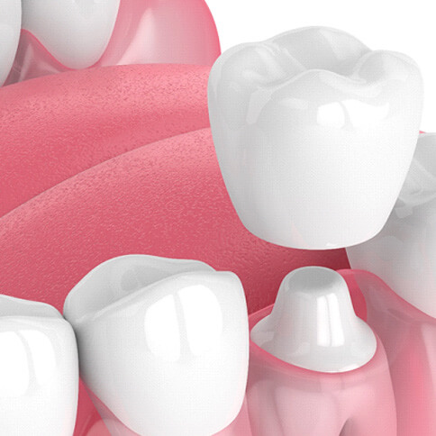 illustration of dental crown being fit over tooth