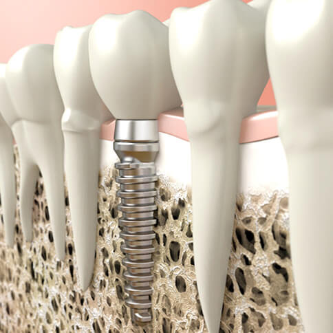 Digital illustration of a dental implant