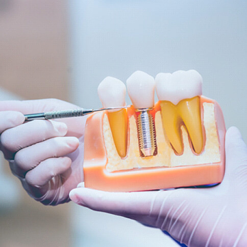 Dentist pointing toa dental implant model