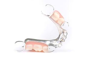 Partial denture with metal attachments