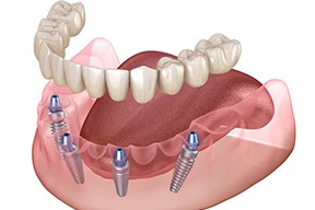 Illustration of implant dentures