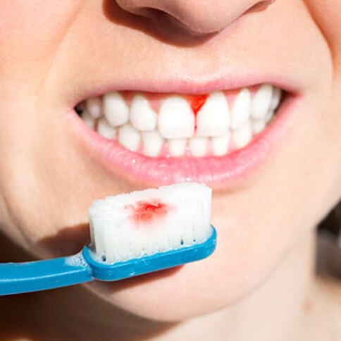 a woman whose gums bleed while she brushed her teeth
