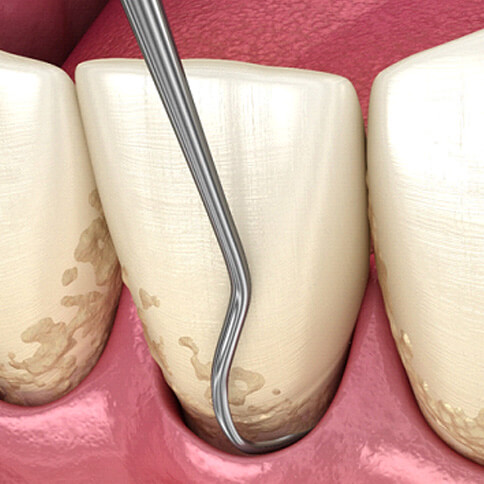 A 3D illustration of scaling and root planing