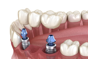 Illustration of an implant bridge