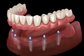Illustration of an implant denture