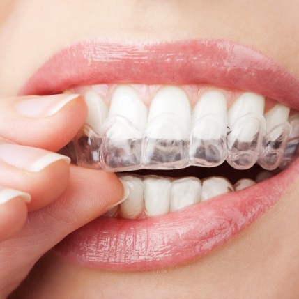 Closeup of dental patient placing Invisalign tray to correct bite alignment