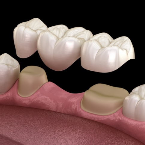 Animated smile during dental bridge placement