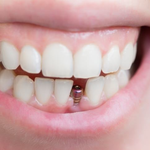 Closeup of smile with newly placed dental implant post