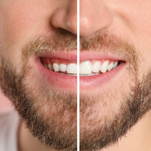 Gum recontouring reshapes your gums