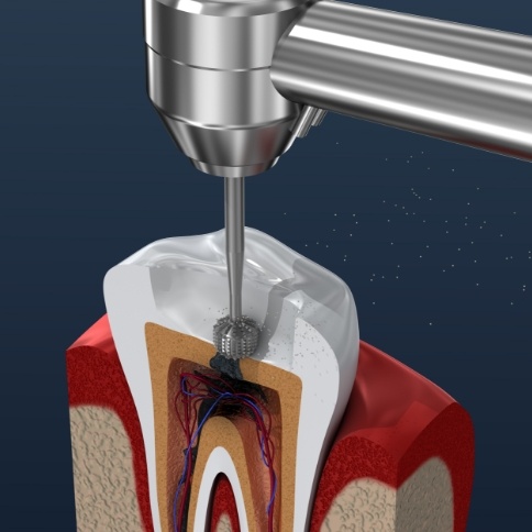 Animated tooth during root canal treatment