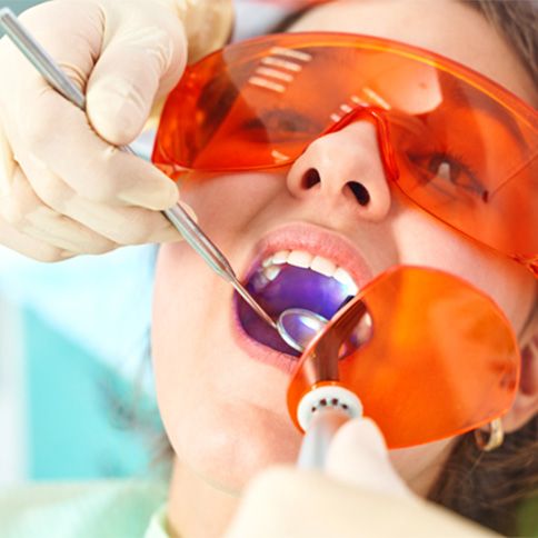 Tooth-colored fillings are durable, natural-looking dental restorations