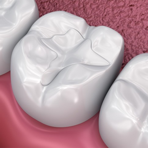 Tooth colored fillings blend in with your natural tooth color