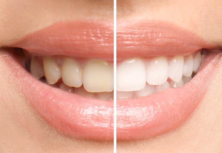 close-up of woman’s smile before and after teeth whitening 