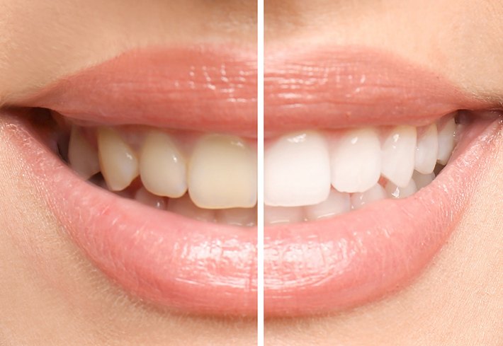 close-up of woman’s smile before and after teeth whitening