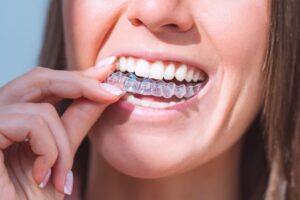 Nose to chin view of woman with brown hair inserting Invisalign