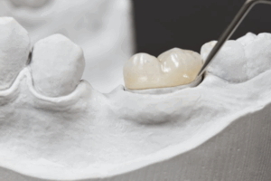Close up shot of a dental bridge sitting on a plaster mold