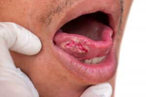 Close-up of person's mouth showing signs of oral cancer.